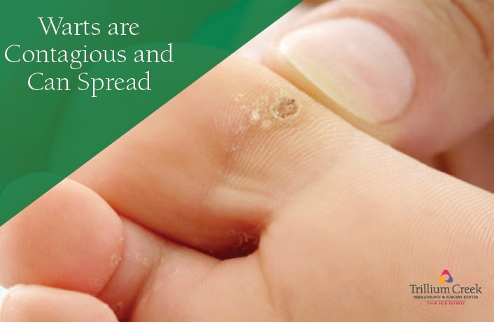 Warts Are Contagious And Can Spread - Trillium Creek Dermatology