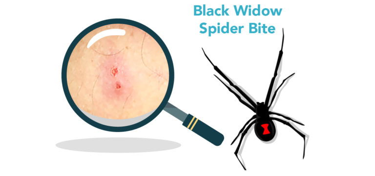 Spider Bites: Symptoms, Treatment, and Prevention