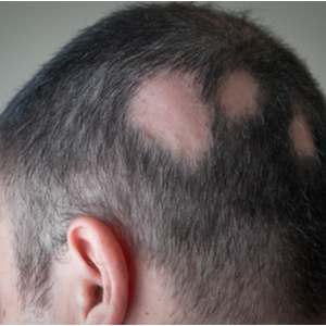 Hair Loss & Diseases Near Me | Dermatologist Ohio