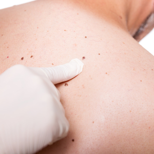 Screening To Save Your Life! How To Find the Best Dermatologist