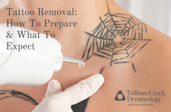 Tattoo Removal: How To Prepare and What To Expect | Trillium Creek Blog