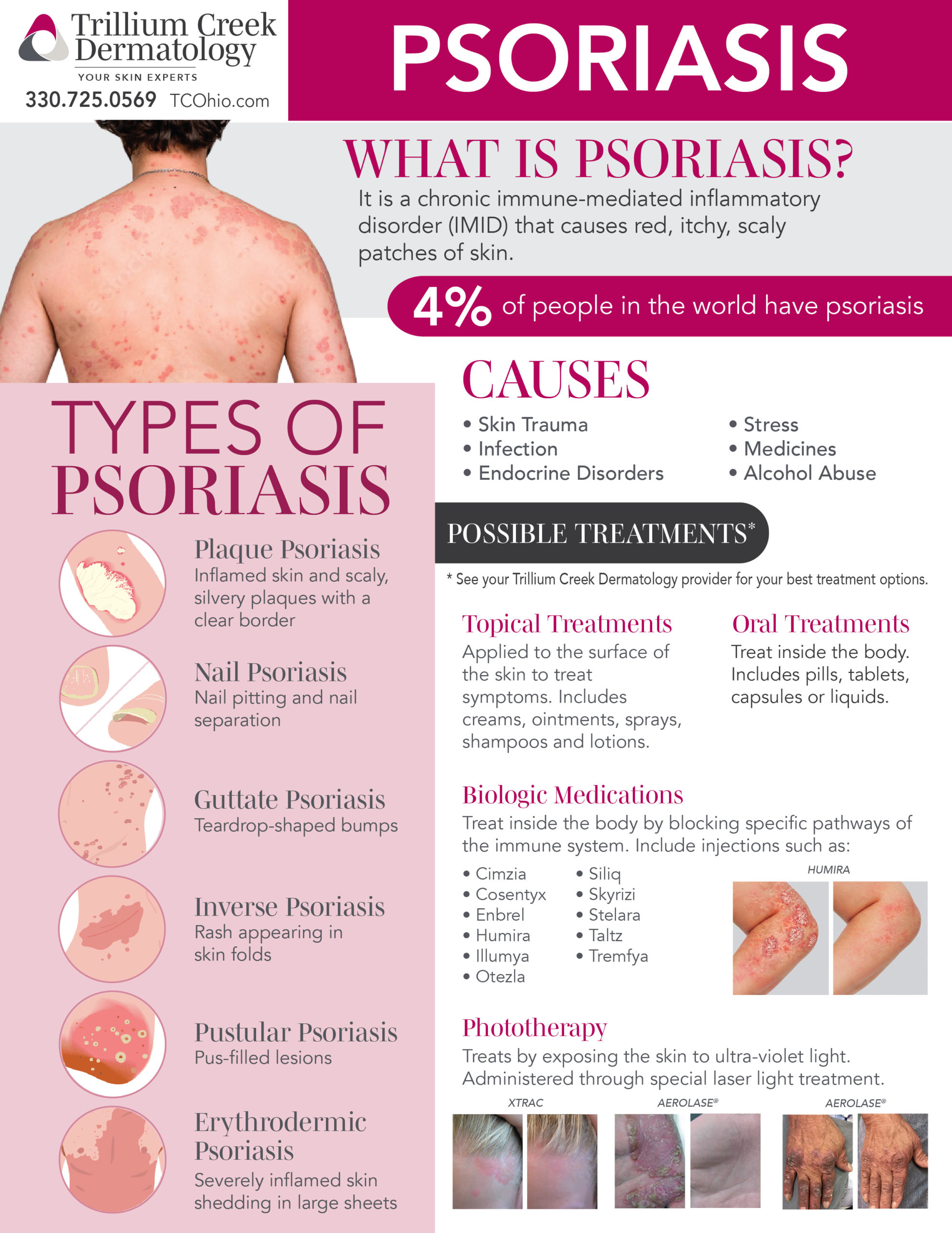 latest research psoriasis treatment