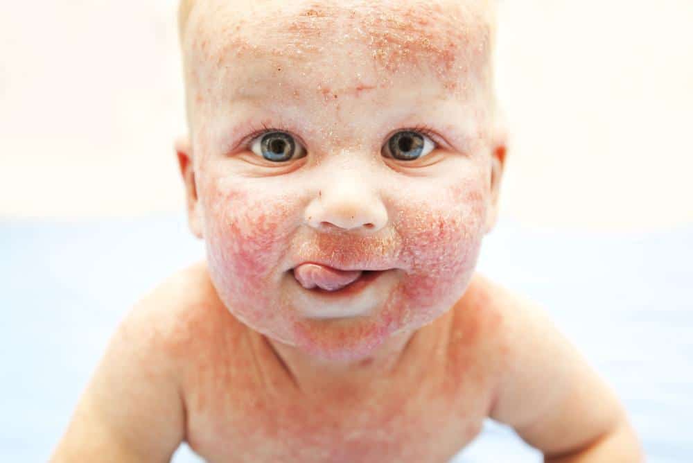 Treating Eczema in Children Trillium Creek Dermatology